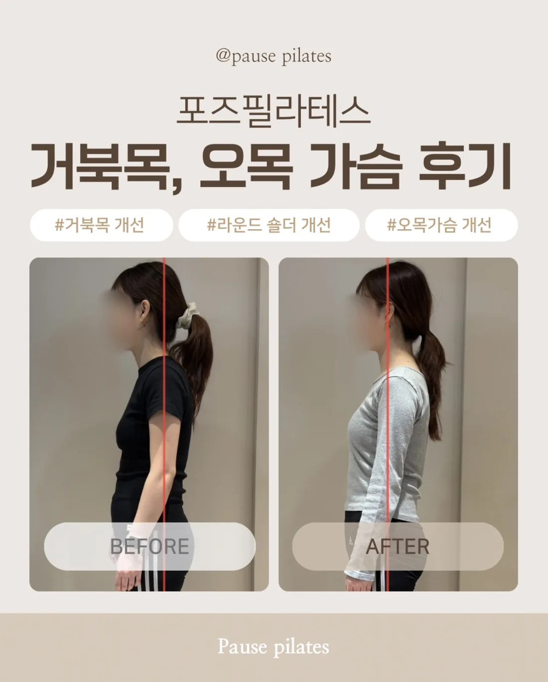 포즈필라테스 비포애프터 거북목 오목가슴