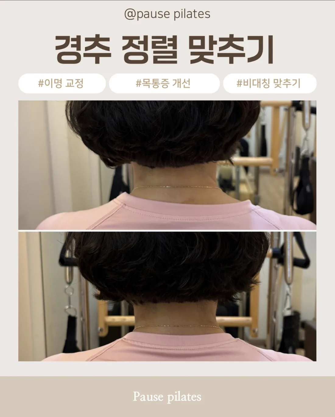 포즈필라테스 비포애프터 경추 정렬 뒷목 라인